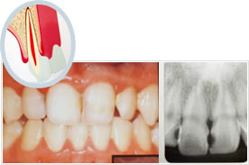歯周病の進行イメージ2
