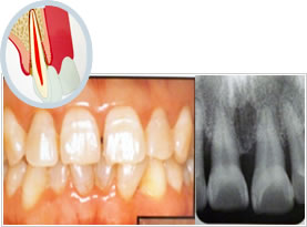 歯周病の進行イメージ4