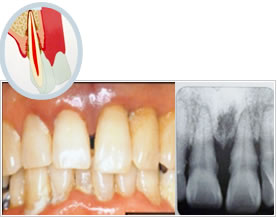 歯周病の進行イメージ5