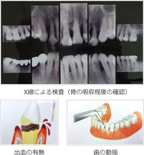 X線による検査（骨の吸収程度の確認）出血の有無 歯の動揺